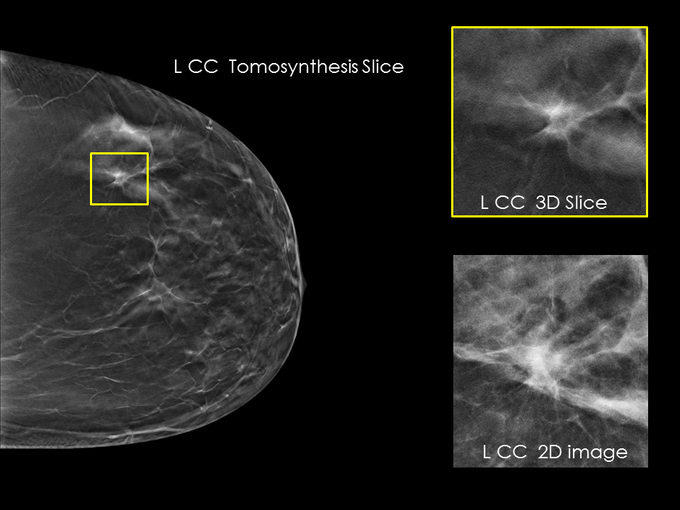 FATTY BREAST